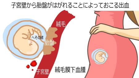 胎盤形成出血|妊娠初期に出血が起きる9つの原因とは？対処手順や。